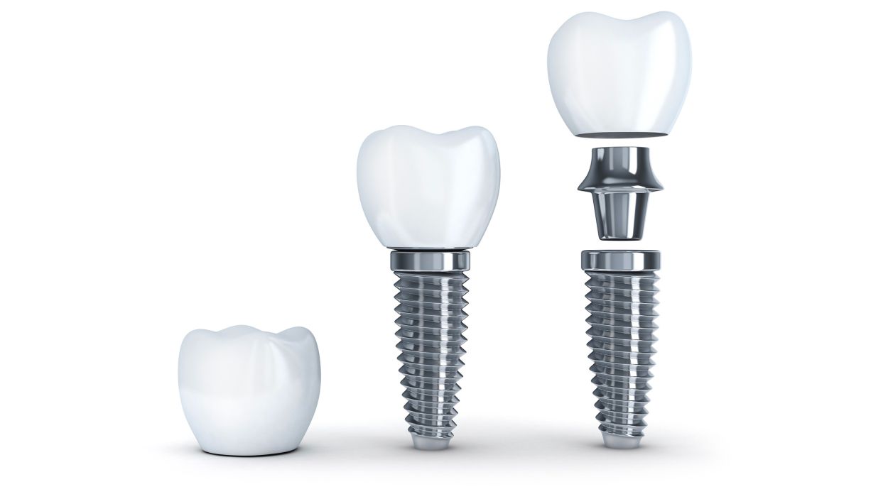 Dental Implants at Serenity